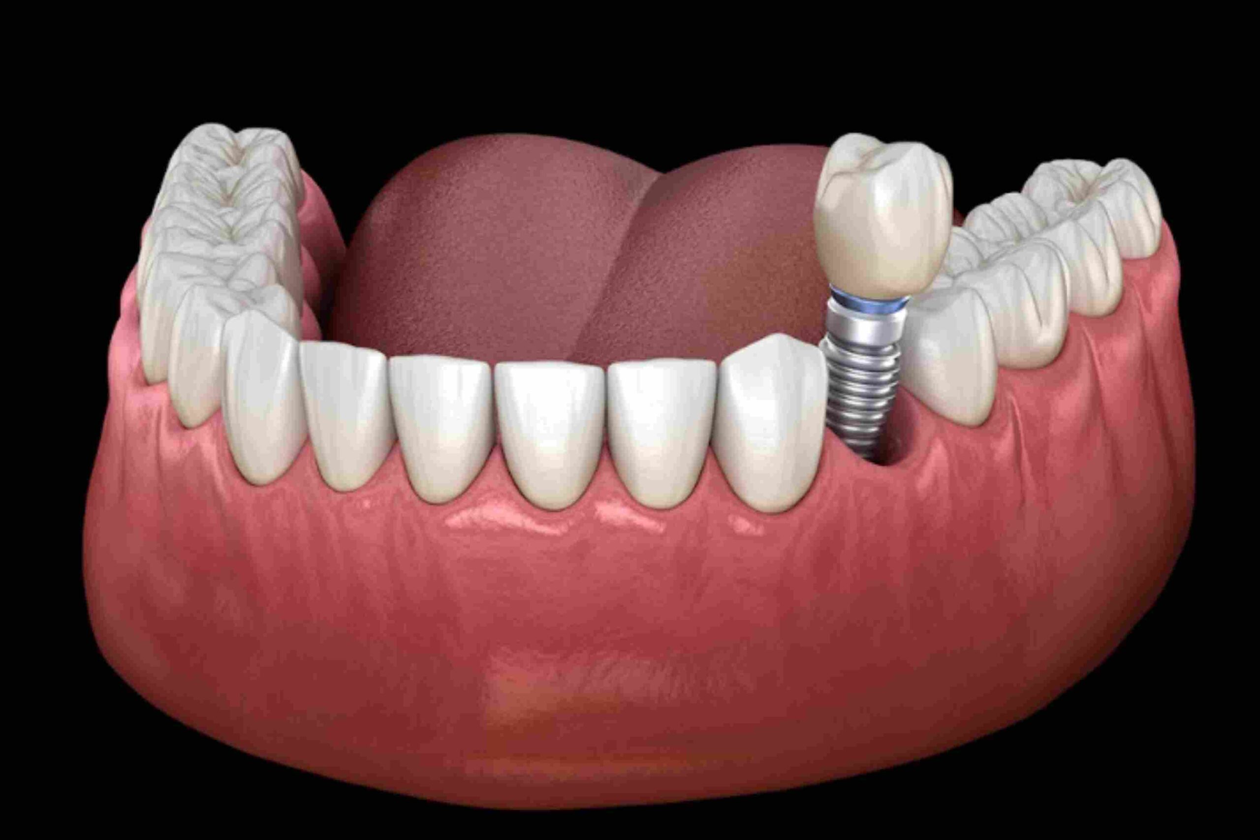 signs you might need dental implants