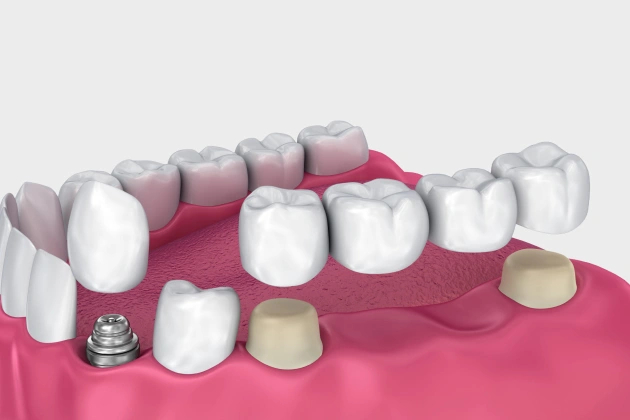 denatl crowns allen tx