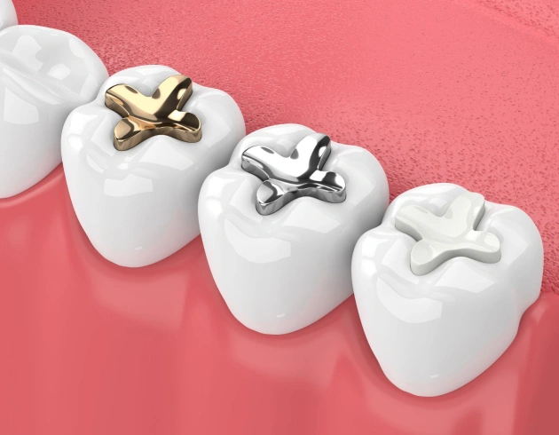 dental fillings allen tx