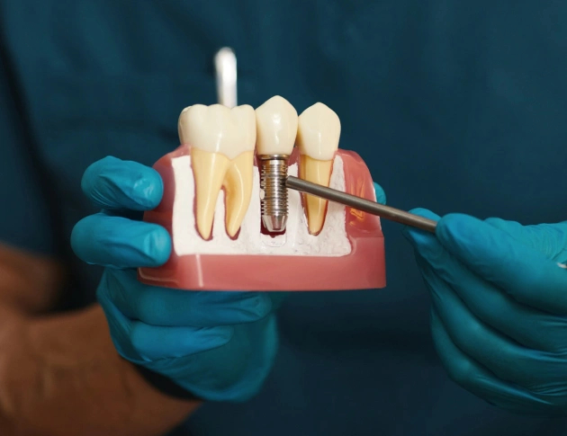 dental implants allen