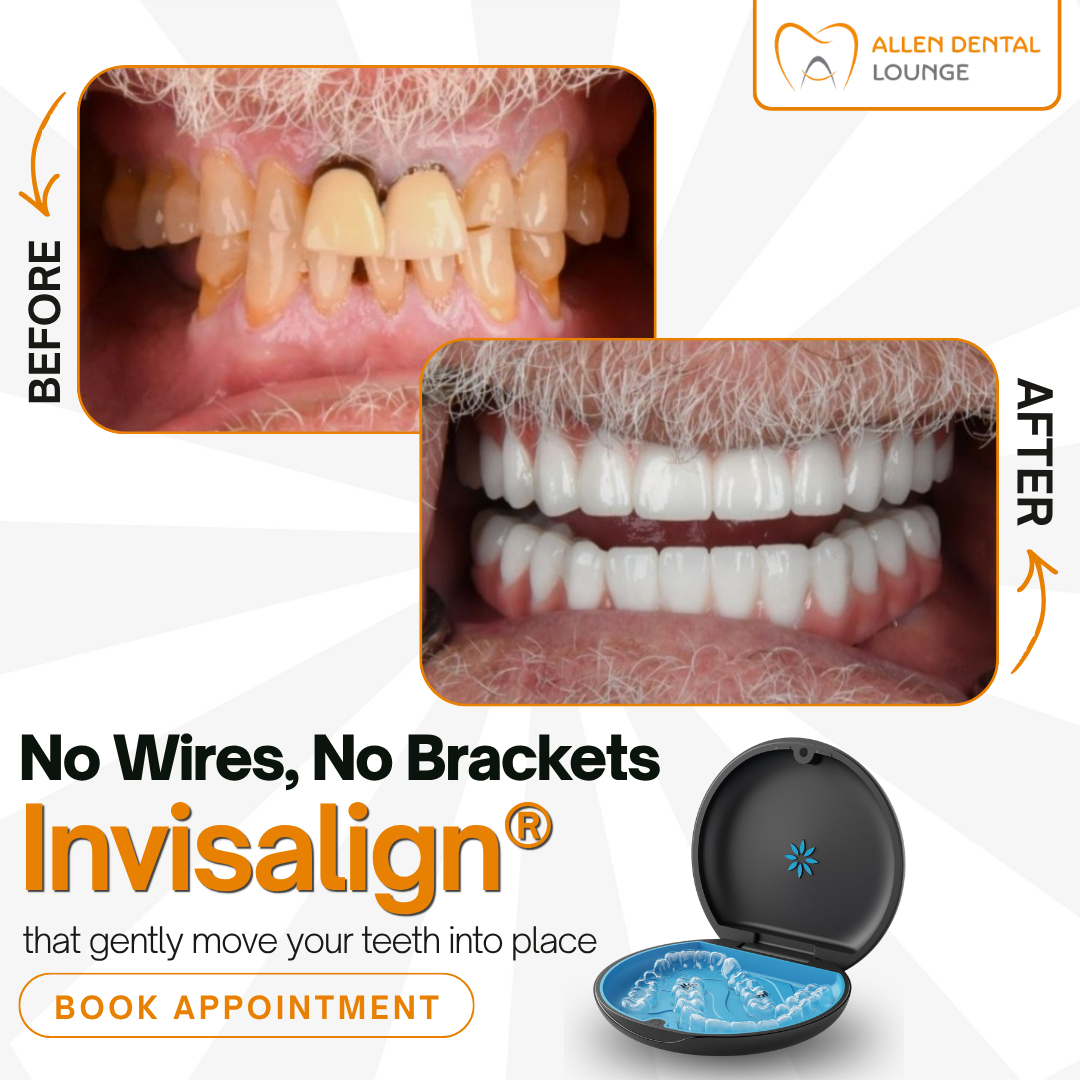 Invisalign before and after — Allen Dental Lounge patient results