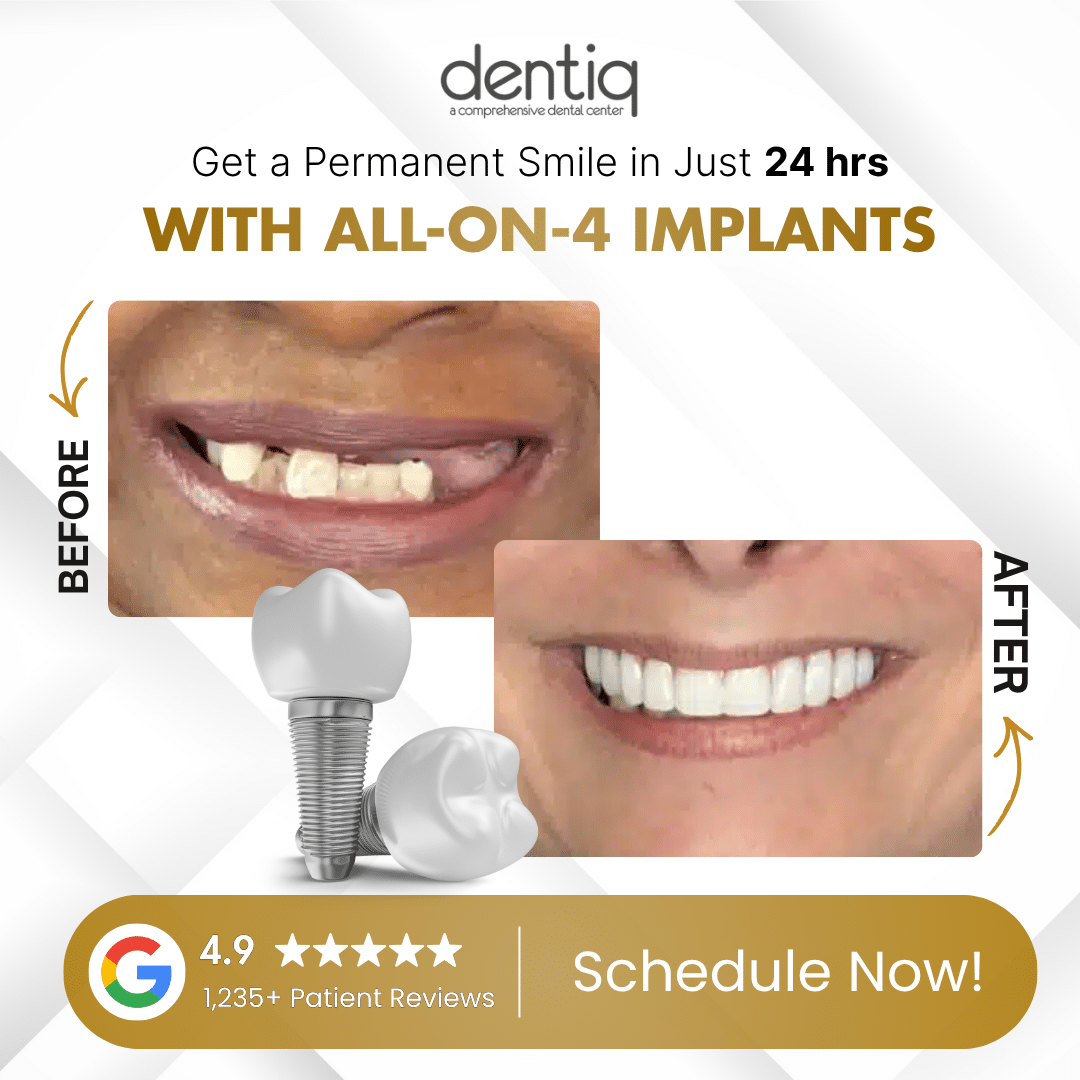 All-on-4 dental implant transformation — Dentiq Dentistry Houston